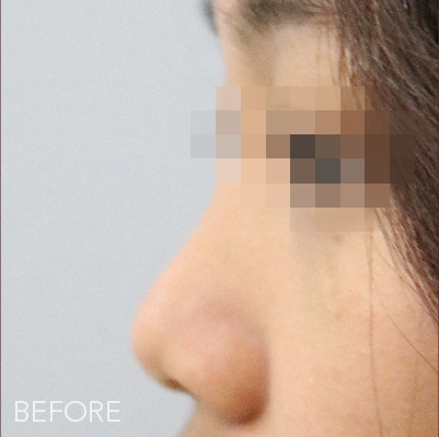 Before treatment
