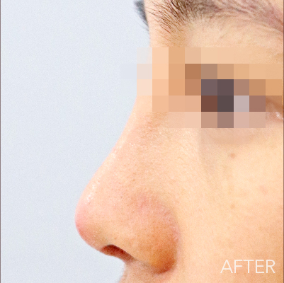 After treatment